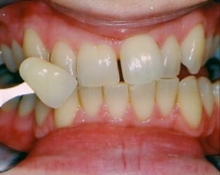 tooth whitening Sheffield, cosmetic dentistry Sheffield, whiter teeth, dentists in sheffield, 